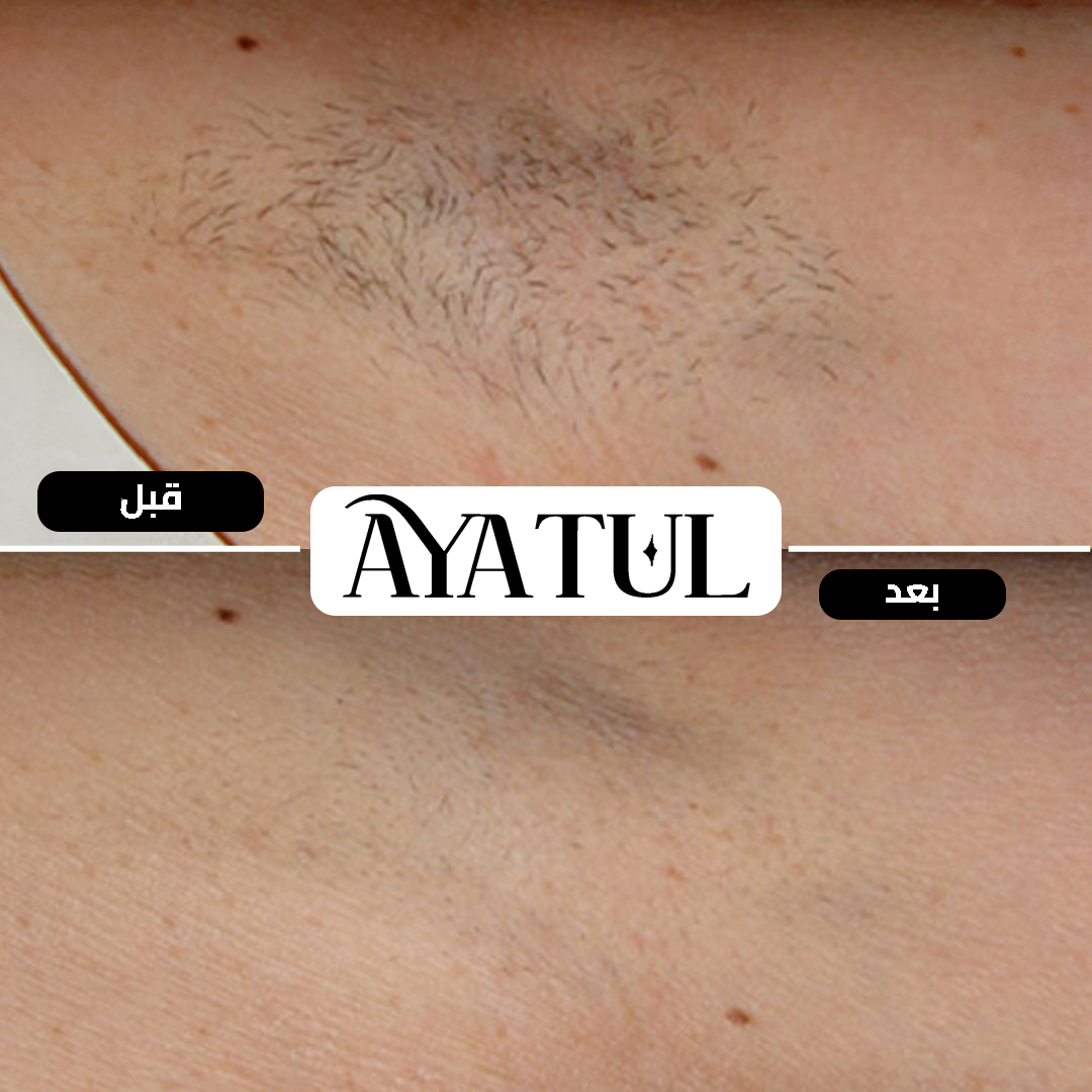® ليزر الشعر الأصلي (IPL)