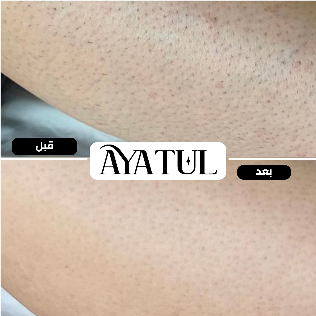 ® ليزر الشعر الأصلي (IPL)